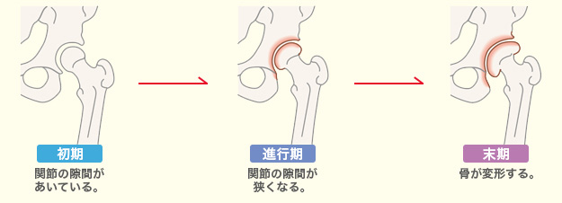 変形性股関節症のメカニズムの図